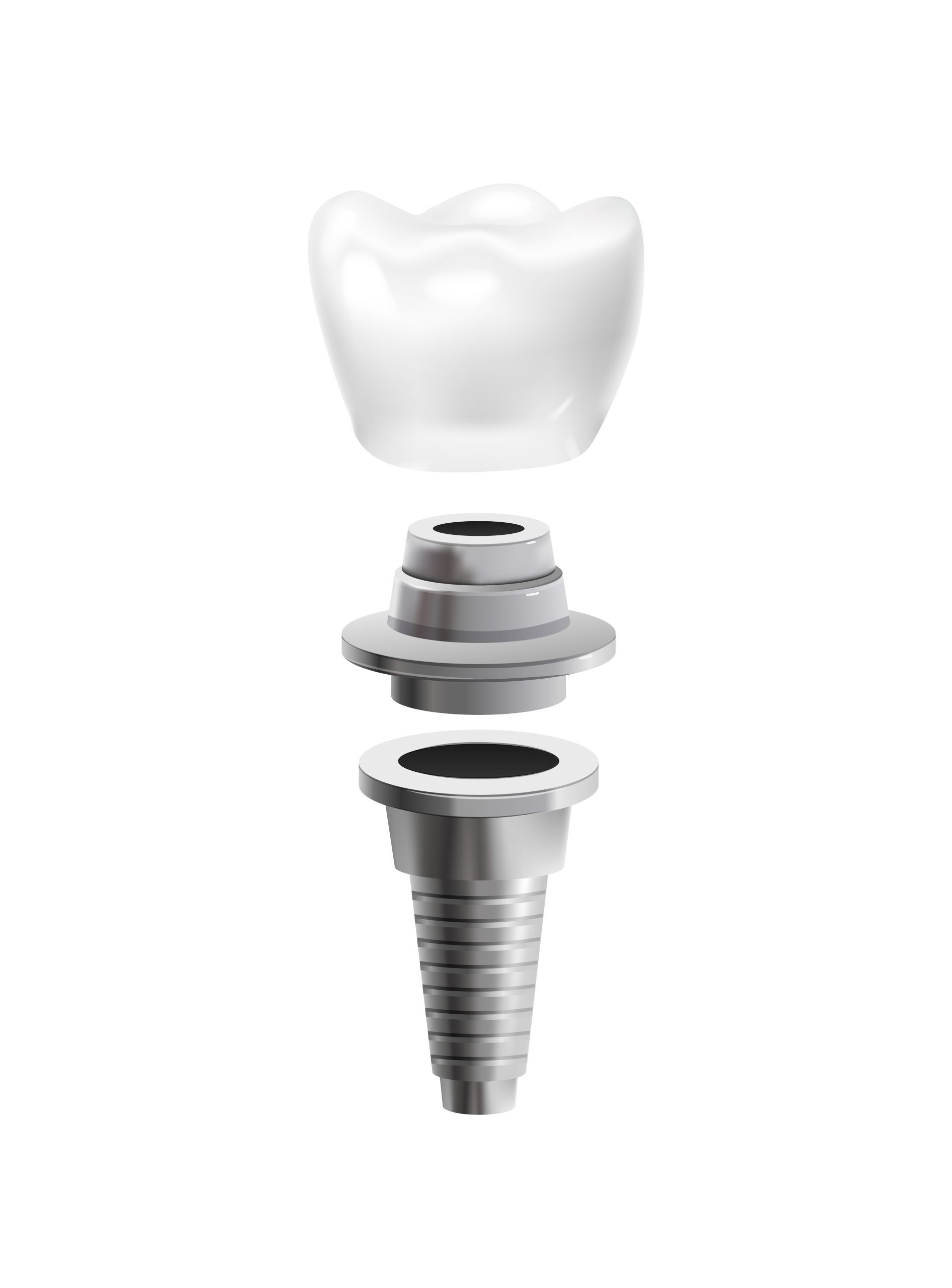 All-on-4 Implants Richmond, TX | Best Dental