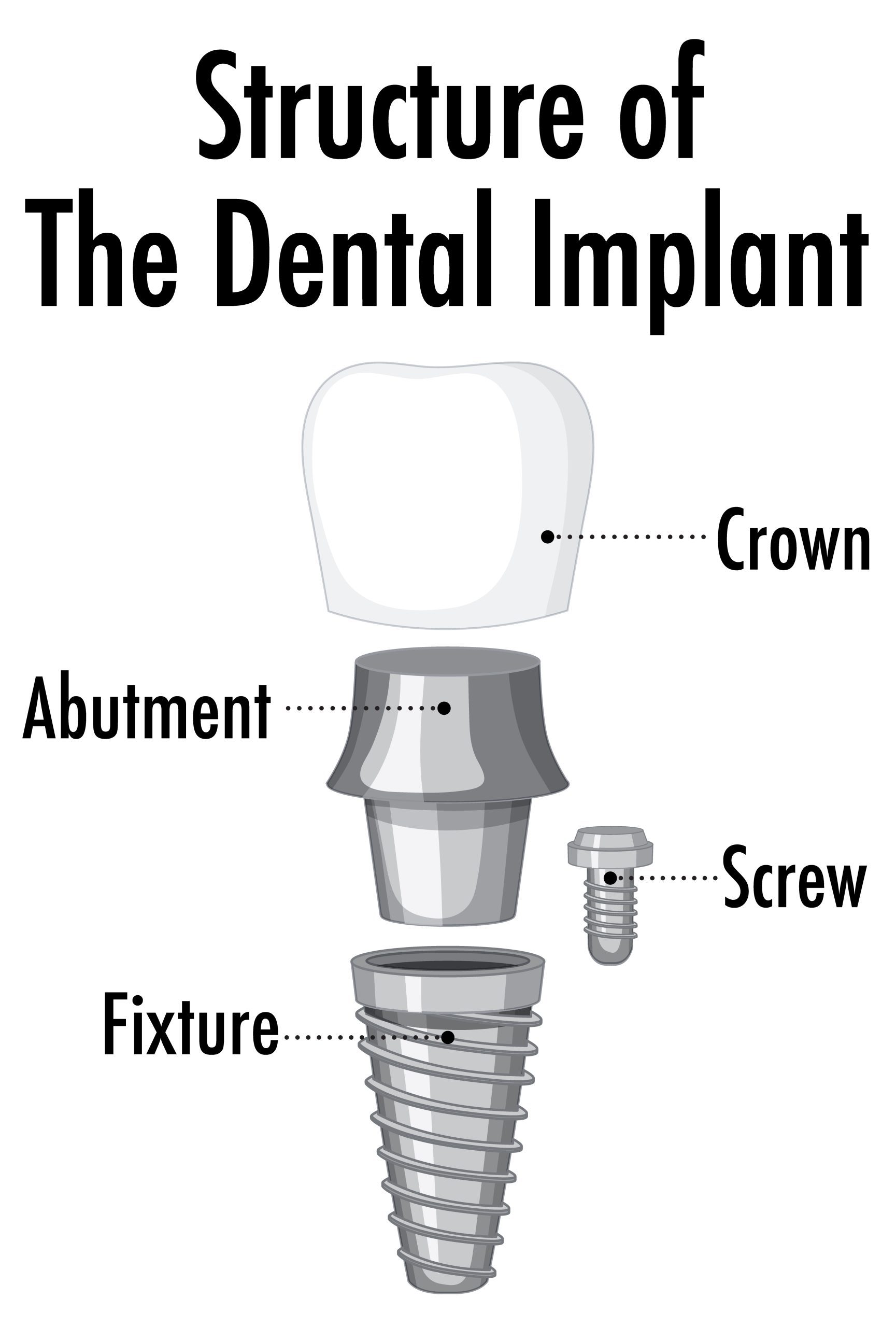 Implant Crown in Richmond, TX | Best Dental