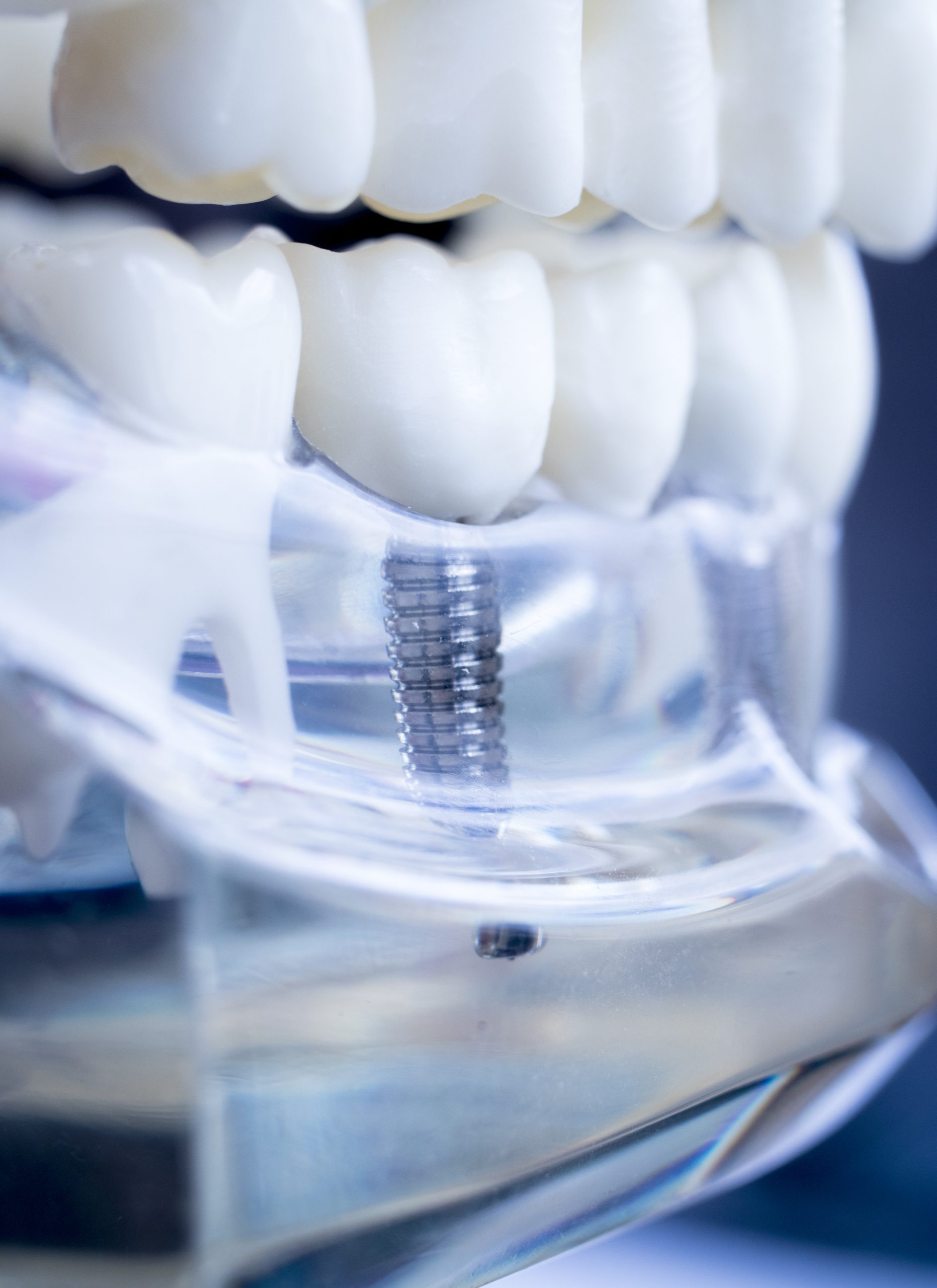 Preparing For Dental Implant Surgery | Best Dental