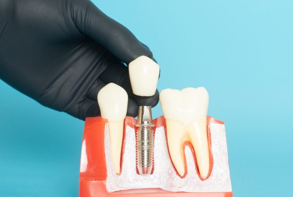 Preparing For Dental Implant Surgery | Best Dental
