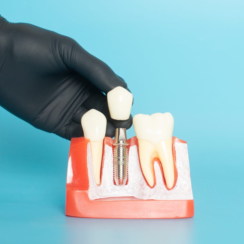 Preparing For Dental Implant Surgery | Best Dental