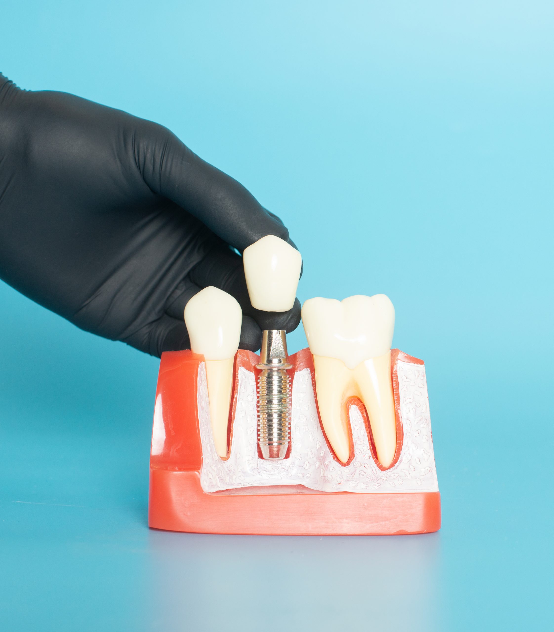 Preparing For Dental Implants Surgery