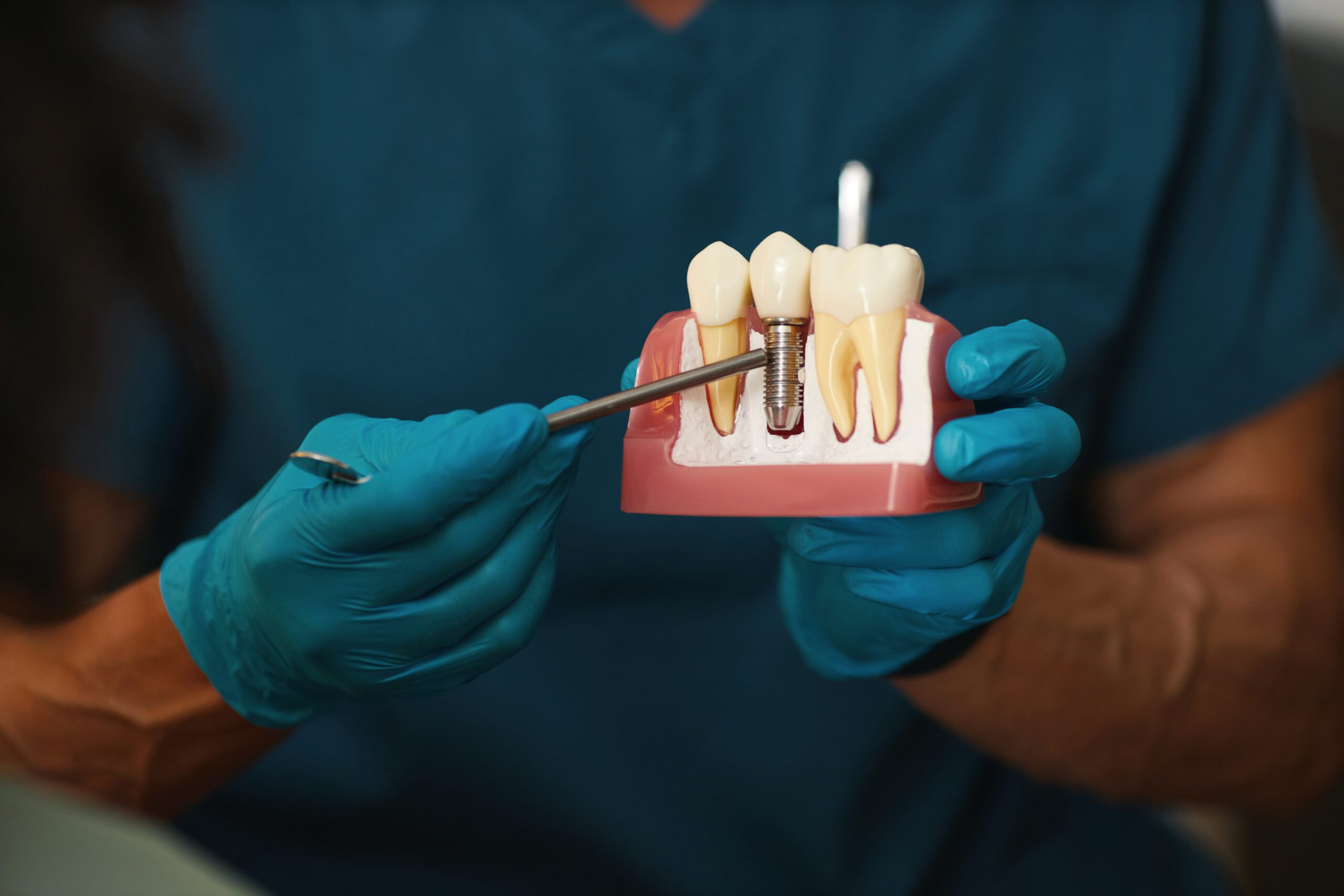 Dental Implants On A Budget | Best Dental Richmond, TX