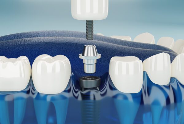 Dental Implants On A Budget | Best Dental Richmond, TX
