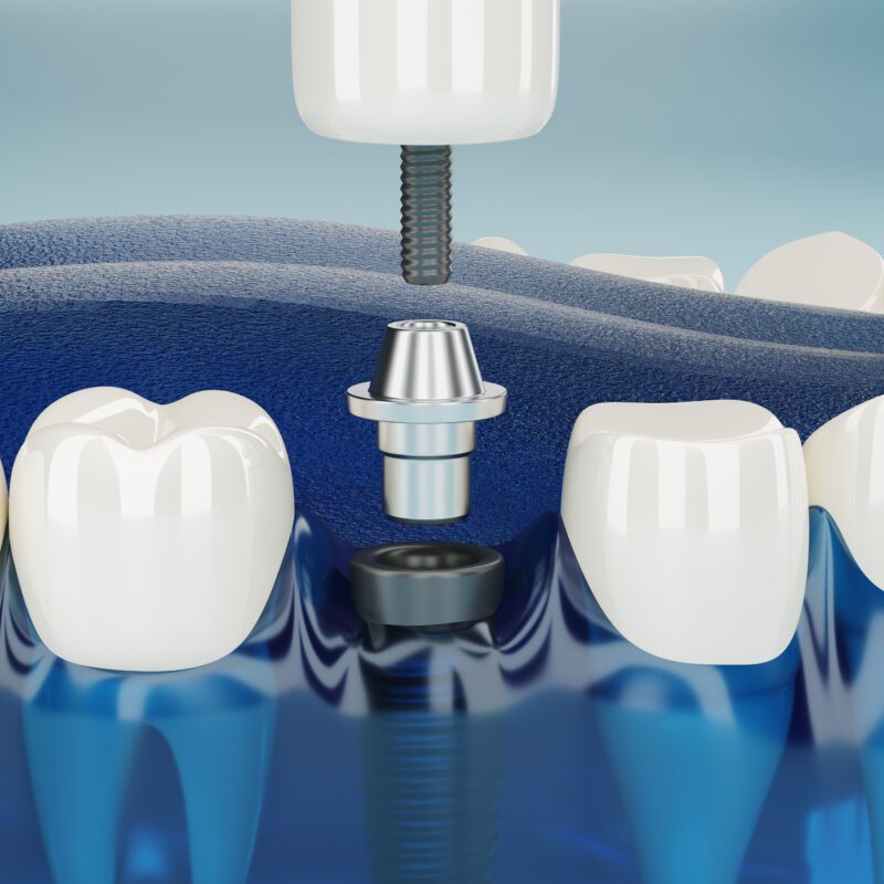 Dental Implants On A Budget | Best Dental Richmond, TX