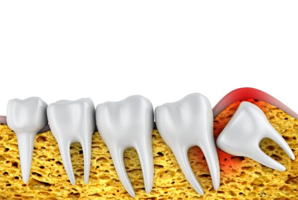 Wisdom Teeth Removal Cost Richmond, TX | Best Dental