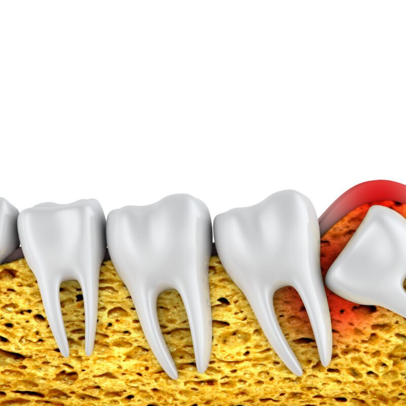 Wisdom Teeth Removal Cost Richmond, TX | Best Dental