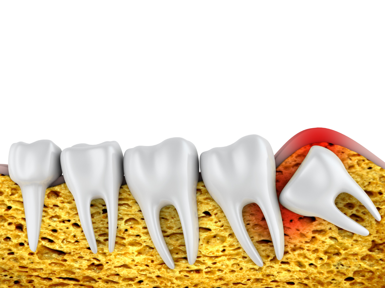 Wisdom Teeth Removal Cost Richmond, TX