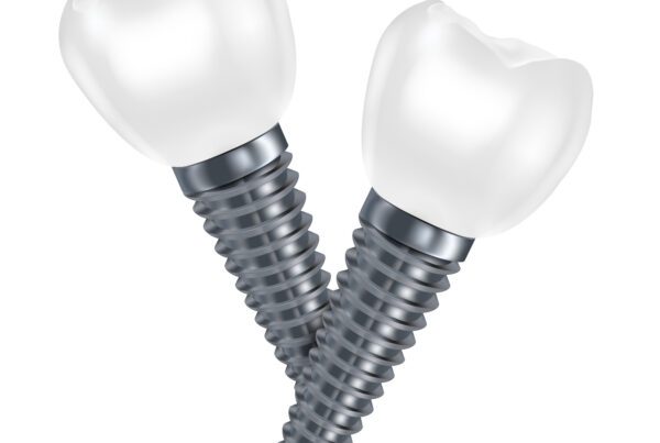 Dental Implants vs Dental Bridges | Best Dental Richmond, TX