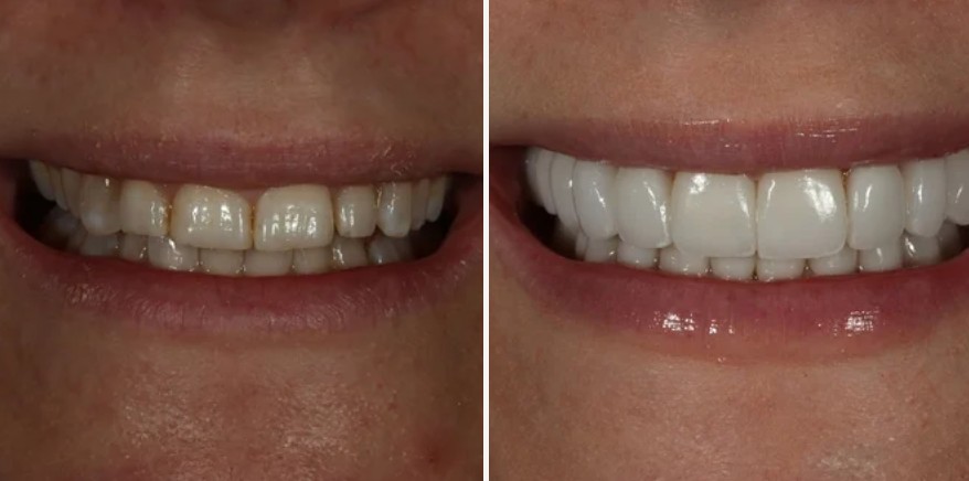 Smile transformation before and after - cosmetic dentistry results