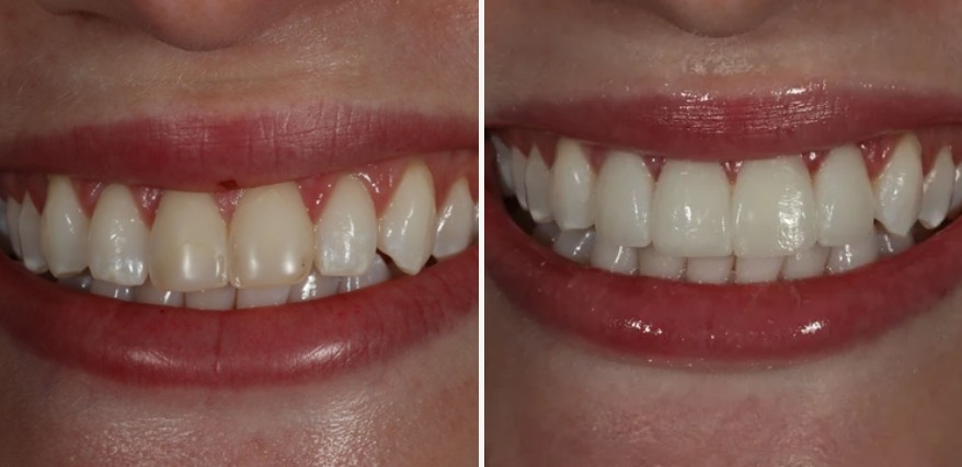 Before and after dental treatment - stunning smile makeover