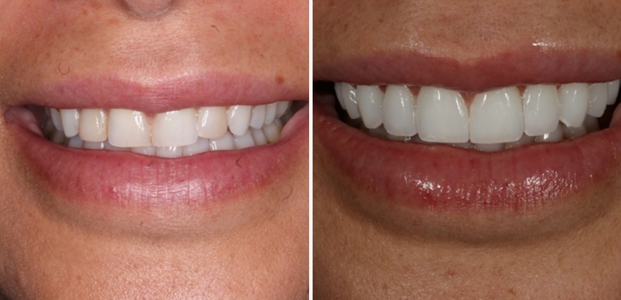 Cosmetic dentistry before after - complete smile transformation