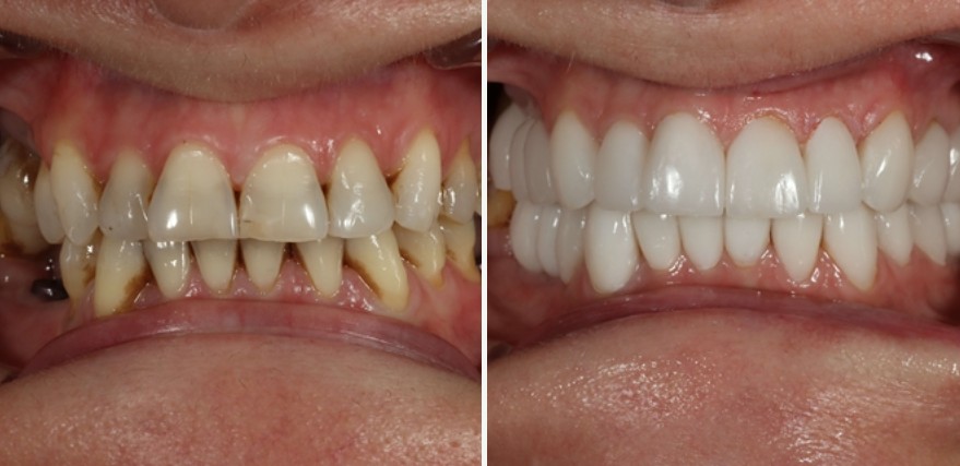 Dental makeover results - before and after comparison