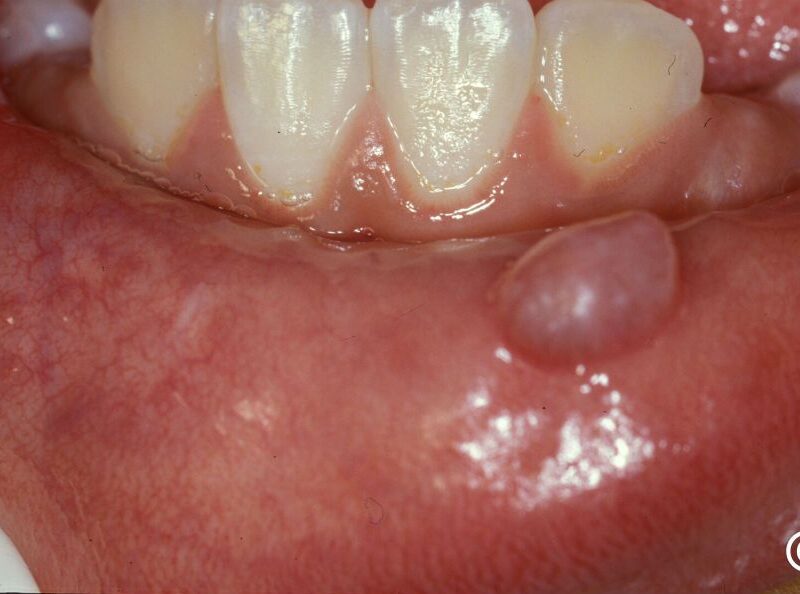 Mucocele and Oral Cyst Removal For Houston Residents | Best Dental in Richmond, TX