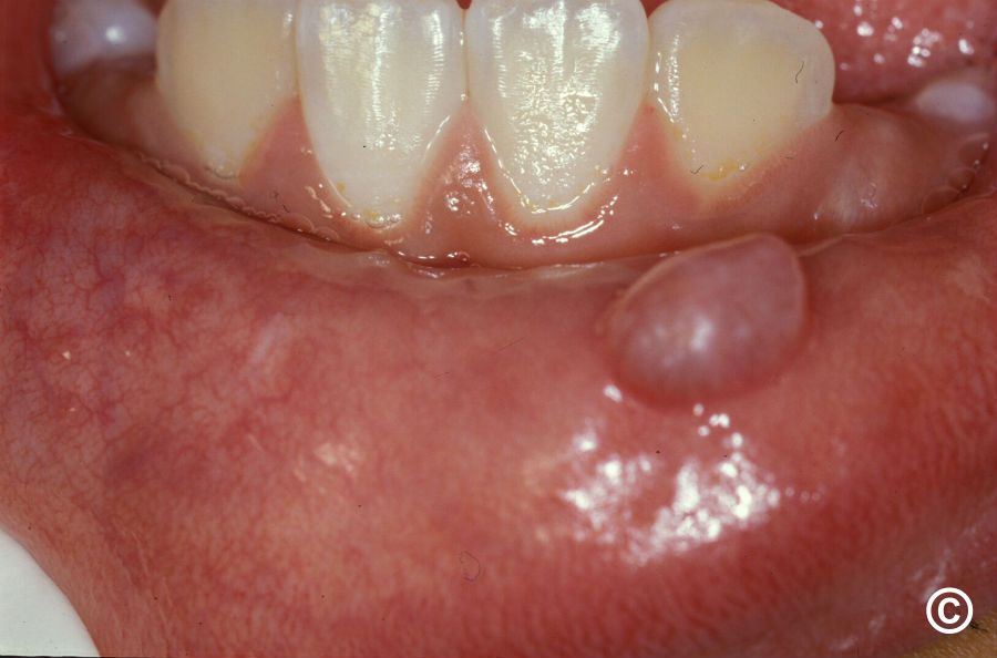 A Complete Guide For Oral Cyst and Mucocele Removal For Houston Residents