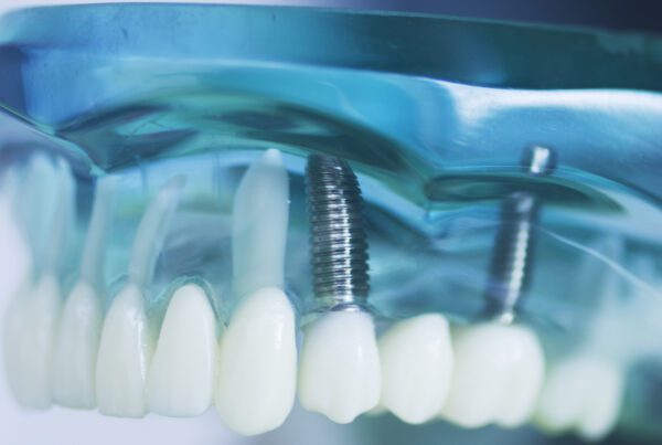 Dental Implants Financing