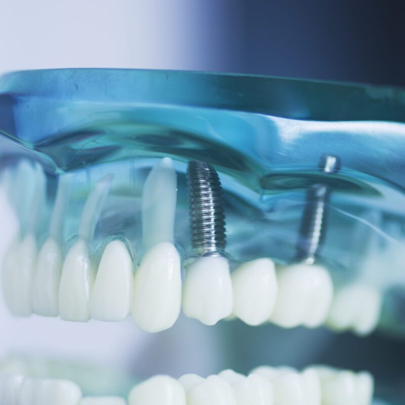 Dental Implants Financing