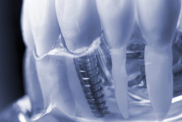 Dental Implants Cost Katy, TX | Best Dental