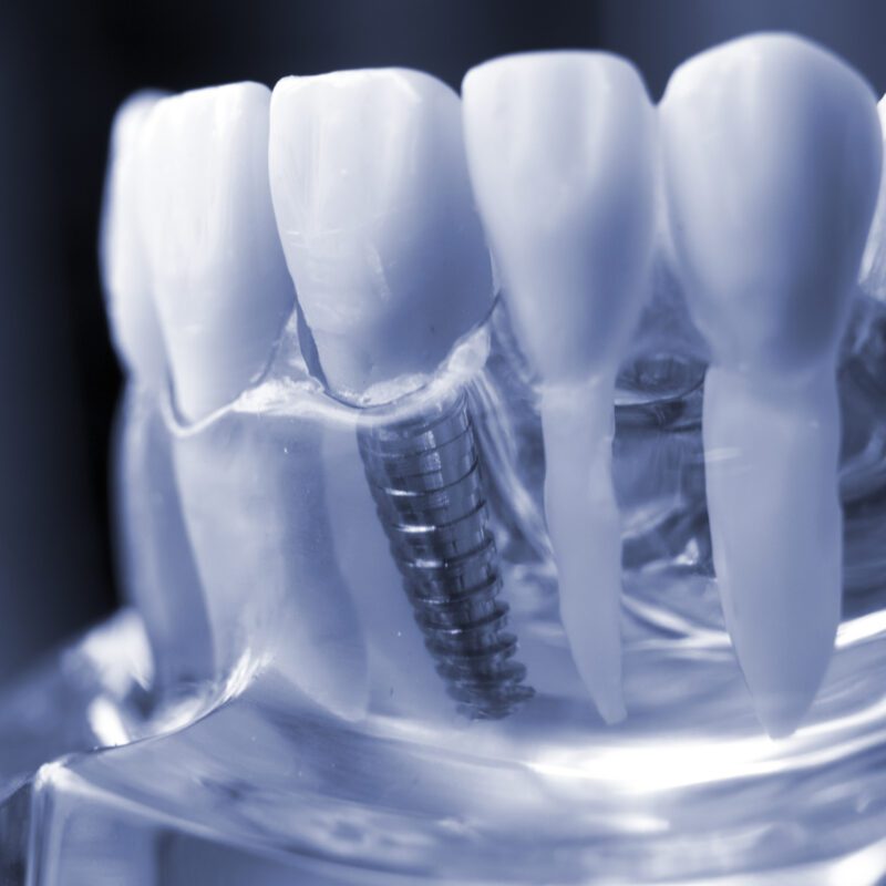 Dental Implants Cost Katy, TX | Best Dental