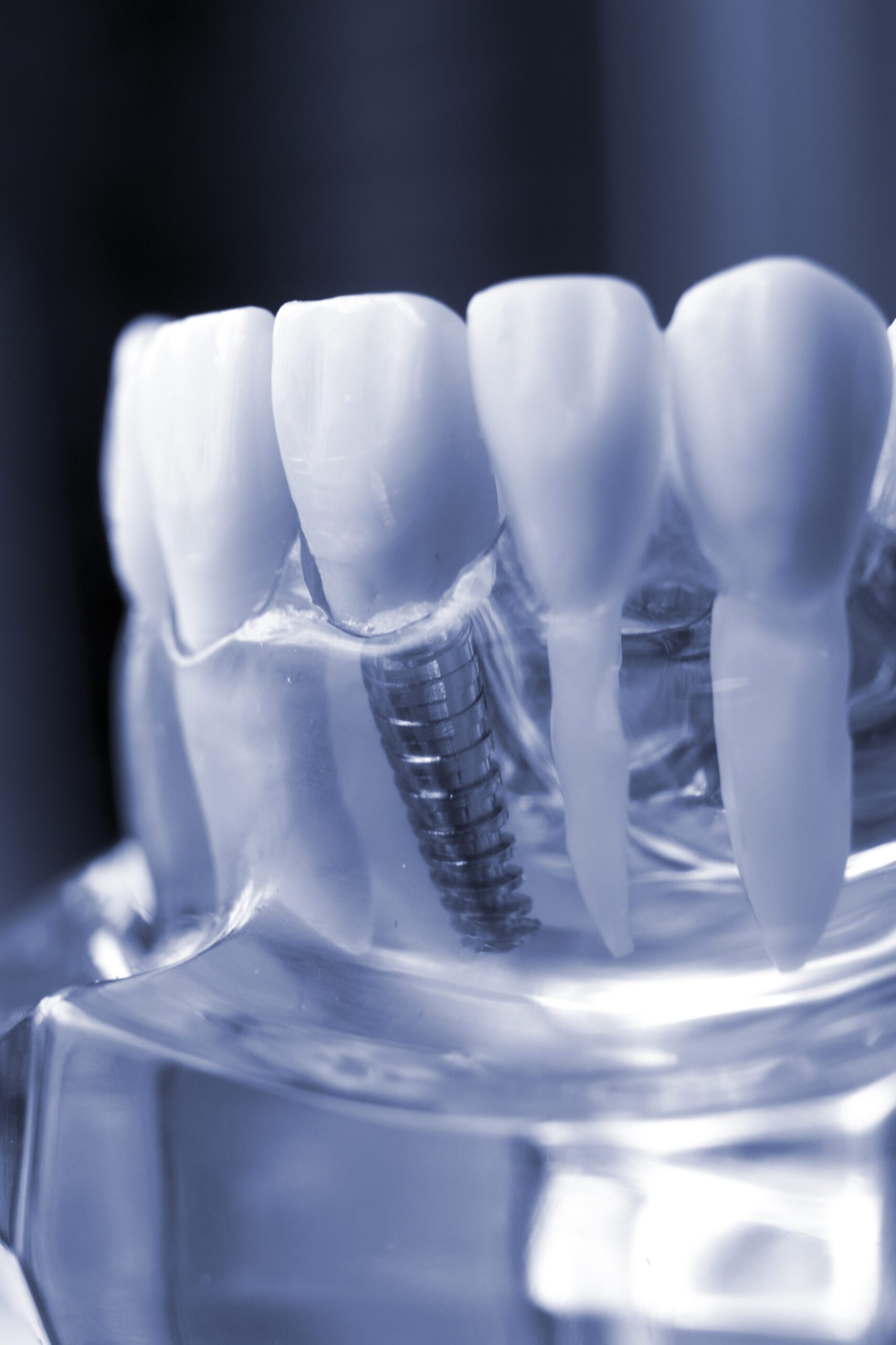How Much Do Dental Implants Cost In Katy, TX?
