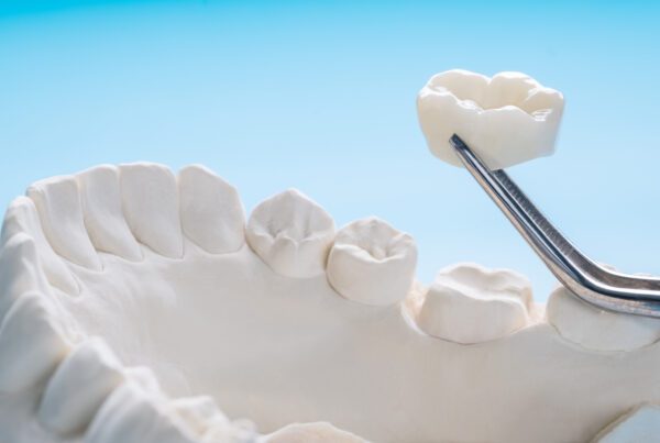 Dental Crown Cost | Best Dental