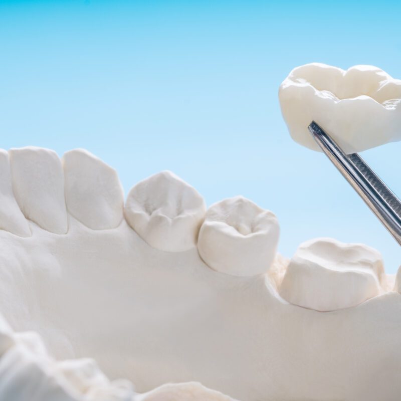 Dental Crown Cost | Best Dental