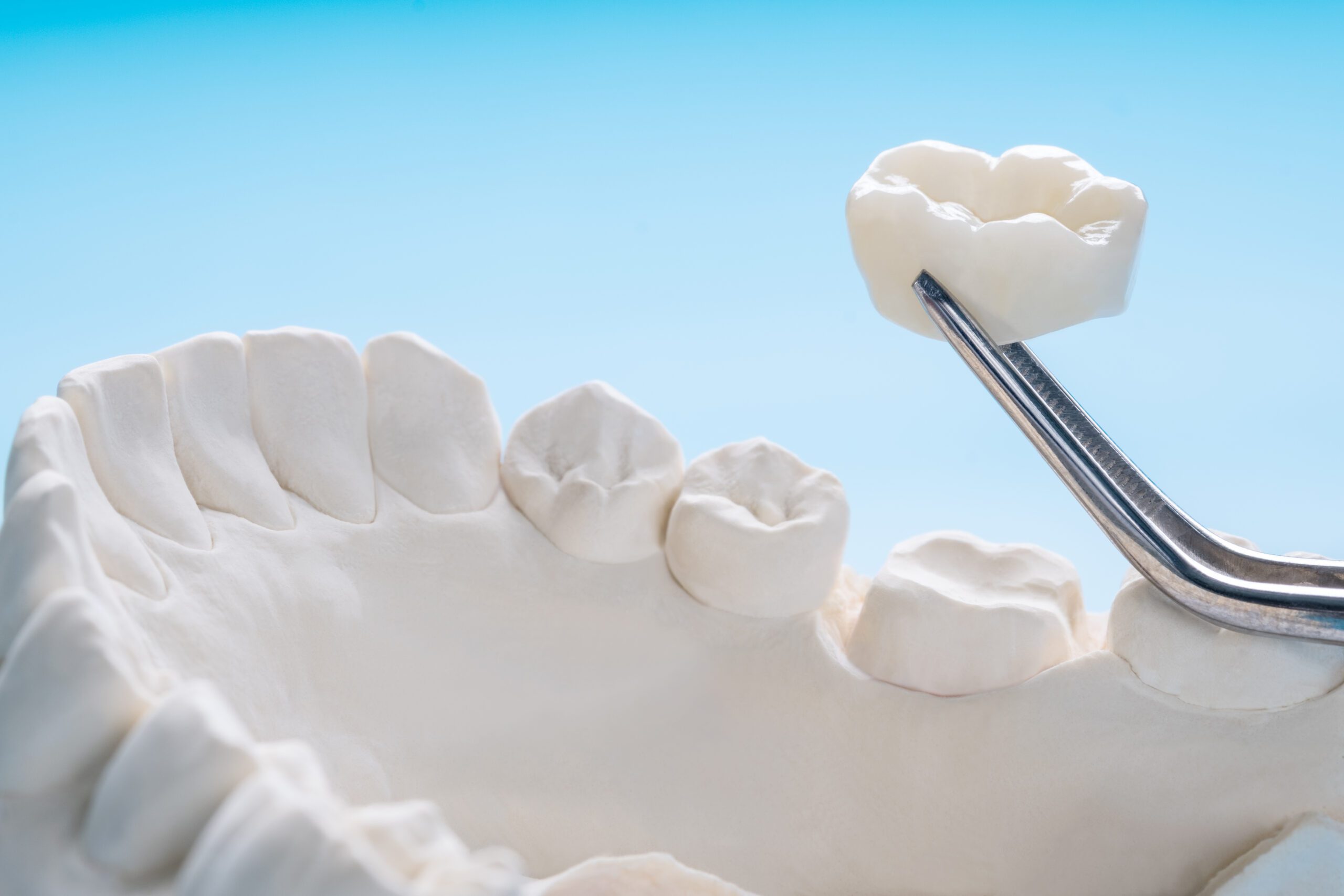 The Cost Of A Dental Crown – A Complete Guide
