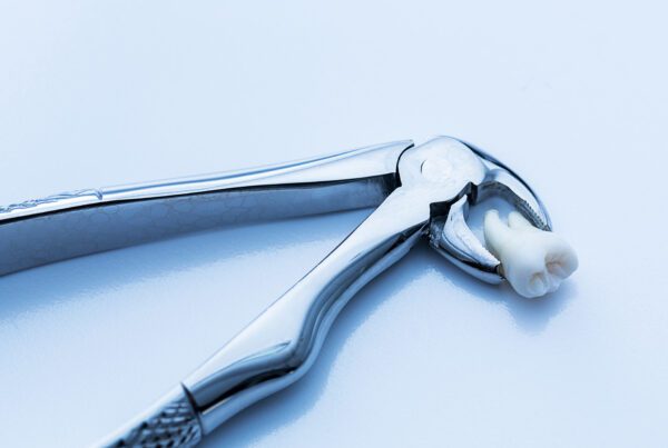 Same-Day Tooth Extractions | Best Dental