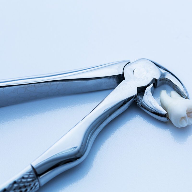 Same-Day Tooth Extractions | Best Dental