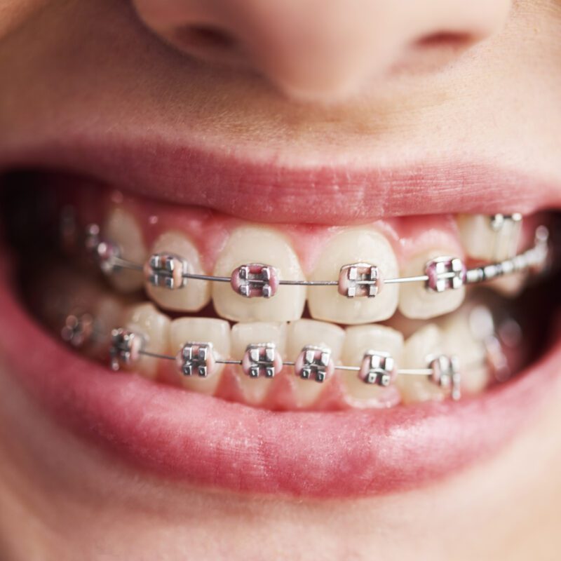 How Much Do Dental Braces Cost? | Best Dental