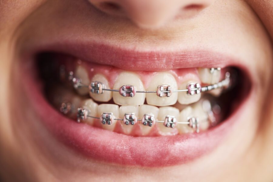 How Much Do Dental Braces Cost? | Best Dental
