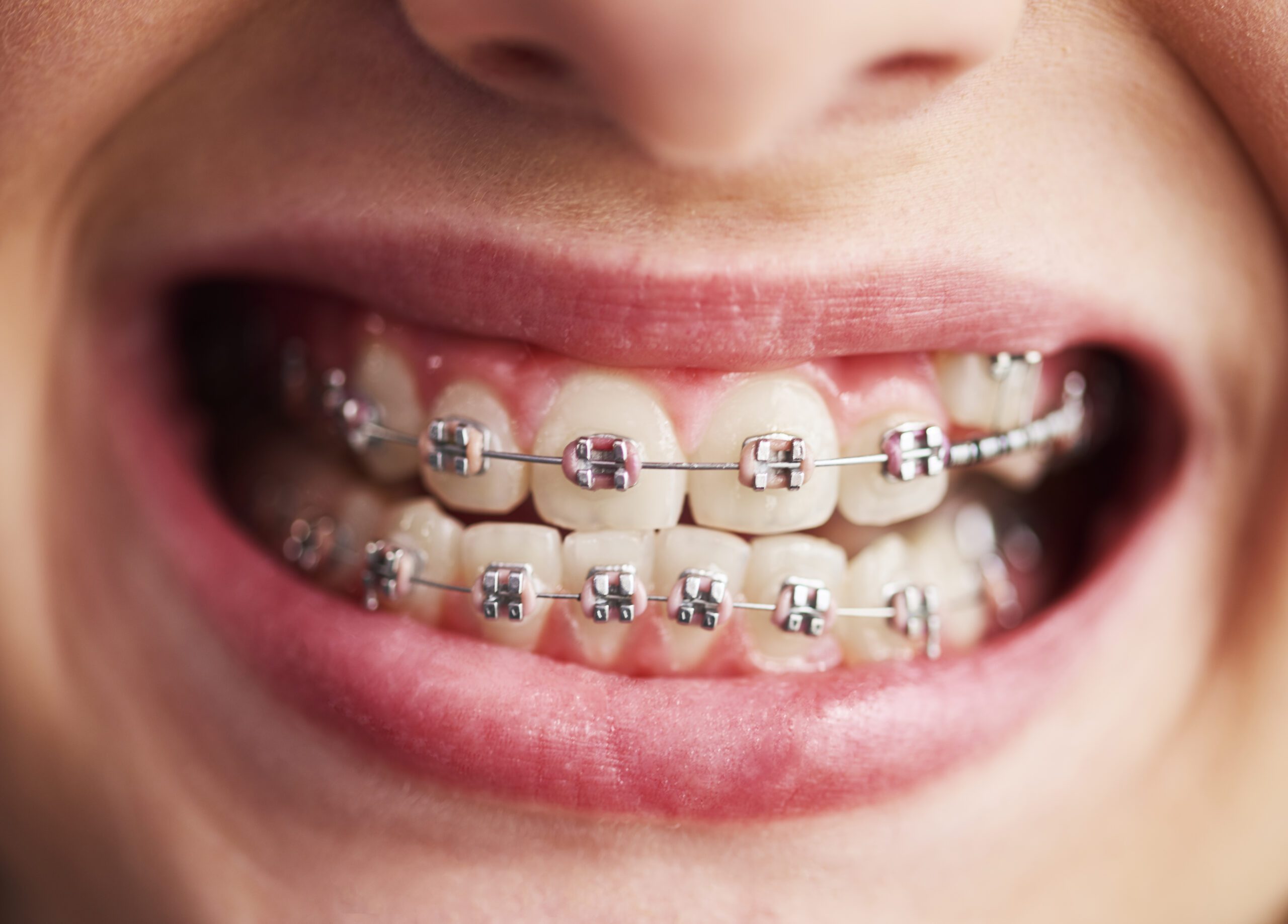 How Much Do Dental Braces Cost? A Complete Guide