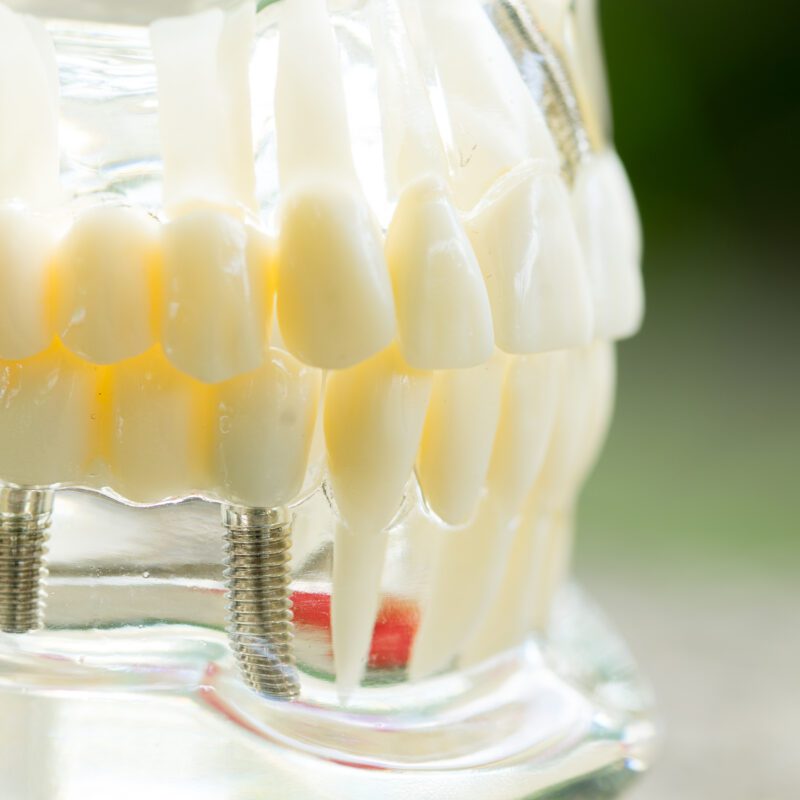 Dental Implants Cost Richmond, TX | Best Dental