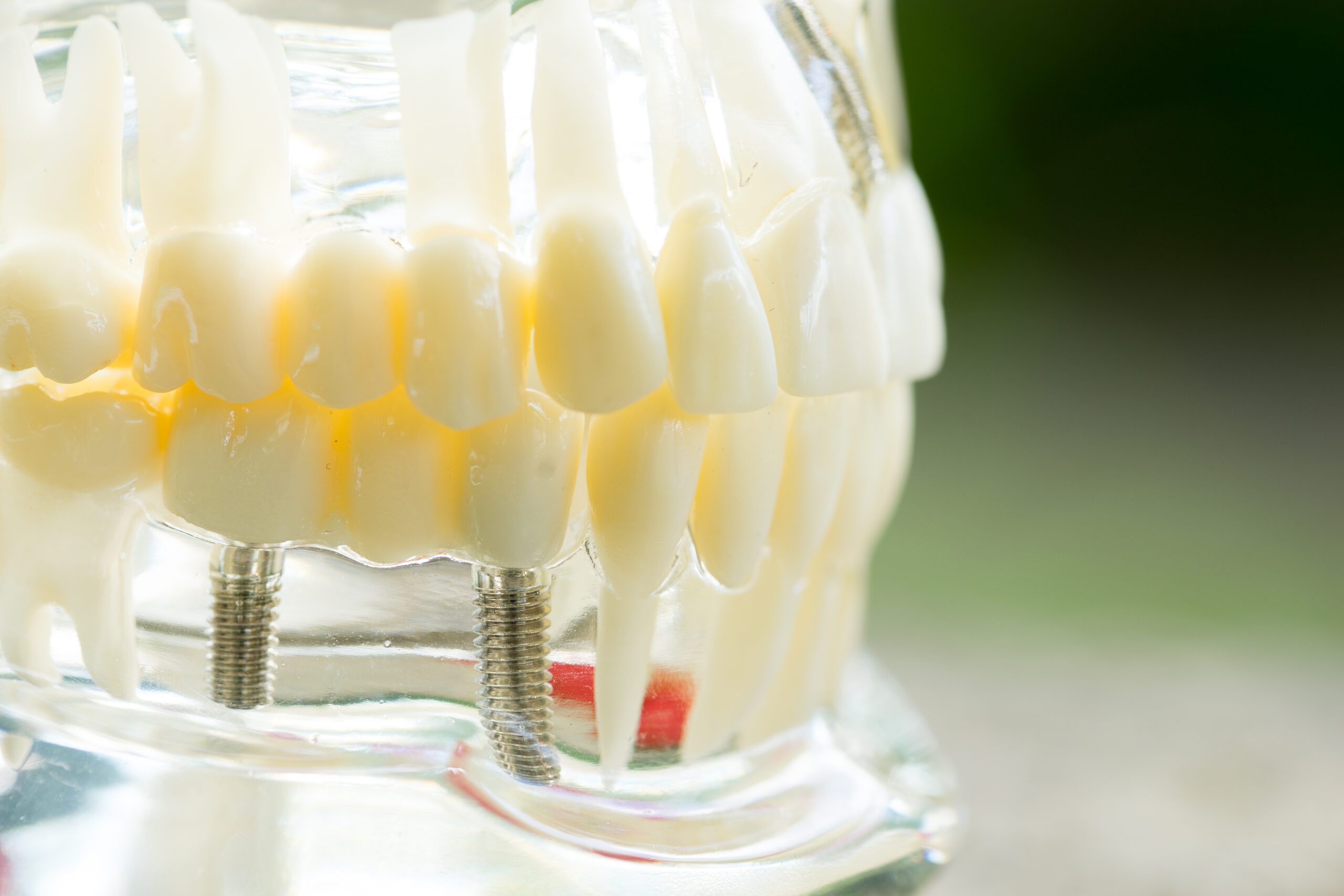 The Cost Of Dental Implants In Richmond, TX