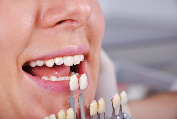 Teeth Whitening Cost Richmond, TX | Best Dental