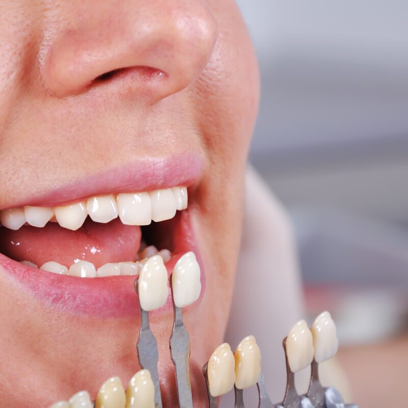 Teeth Whitening Cost Richmond, TX | Best Dental