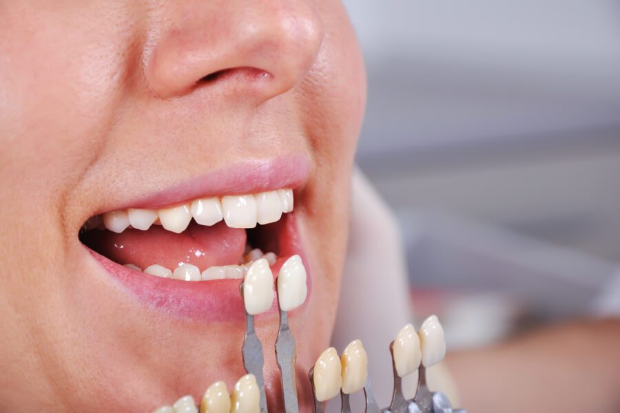 Teeth Whitening Cost Richmond, TX | Best Dental
