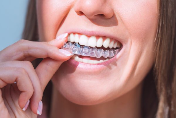 Cavity During Invisalign | Best Dental