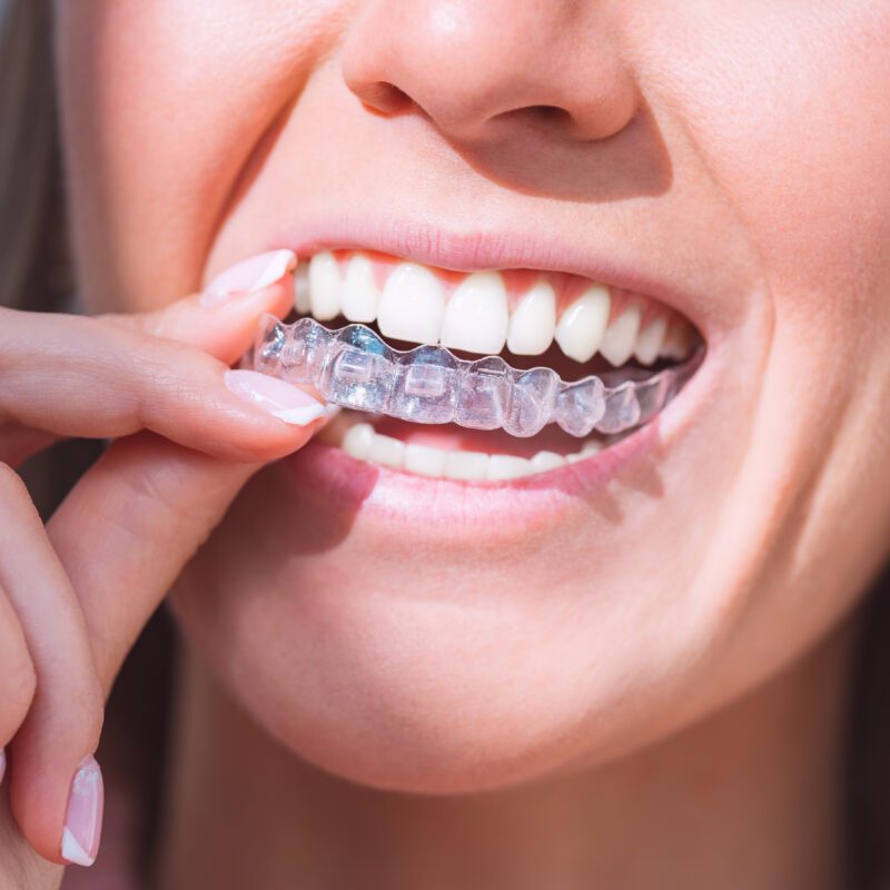 Cavity During Invisalign | Best Dental