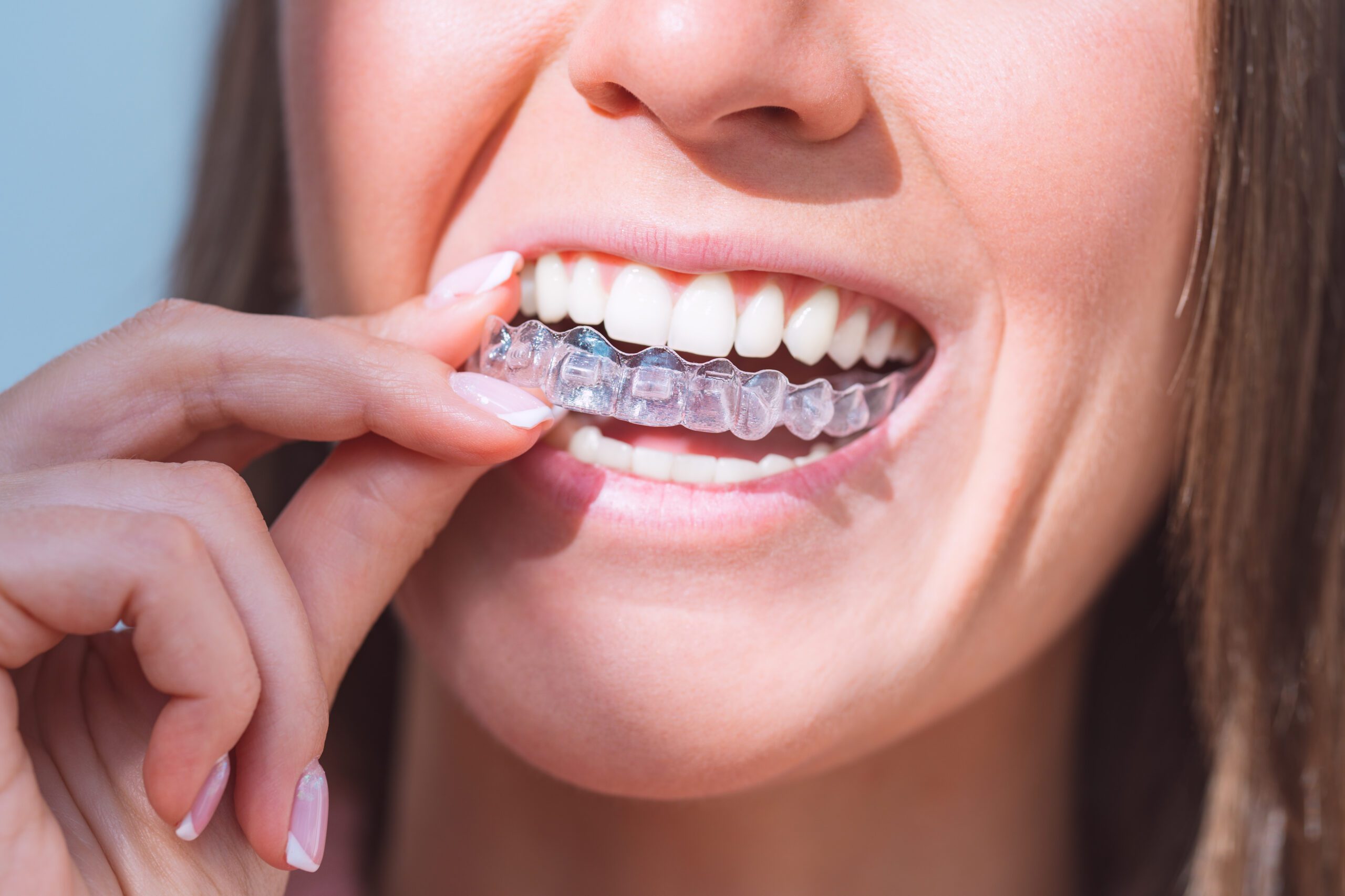 Getting A Cavity While Using Invisalign