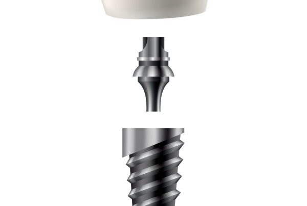 Dental Implants Cost Sugar Land, TX | Best Dental