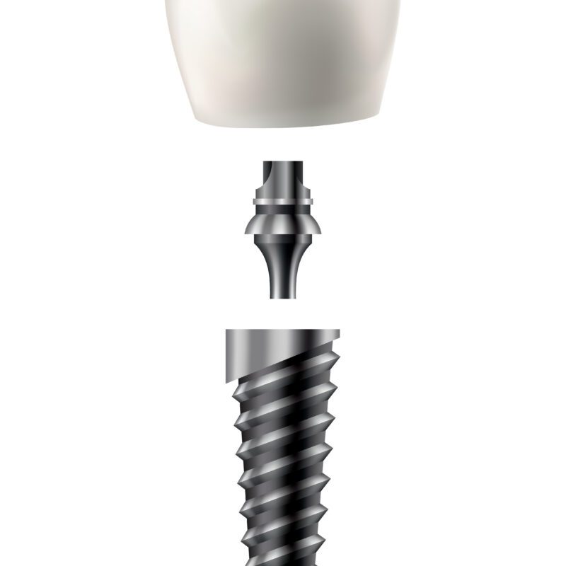 Dental Implants Cost Sugar Land, TX | Best Dental