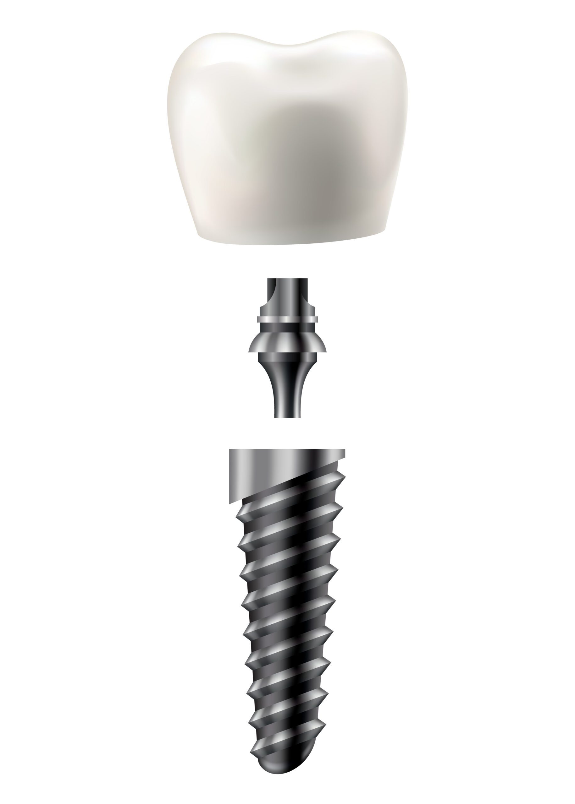 How Much Do Dental Implants Cost In Sugar Land, TX?