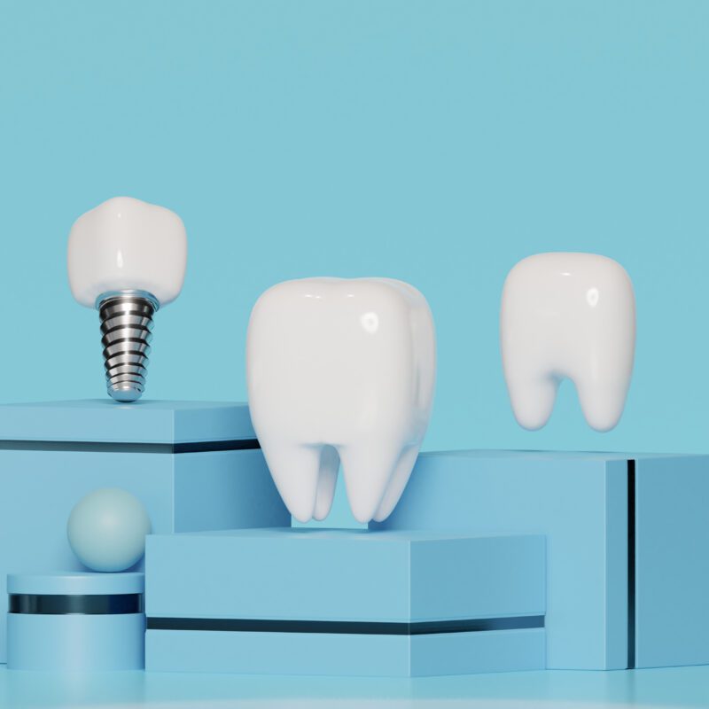 What Houston Residents Can Expect from Dental Implant Surgery | Best Dental