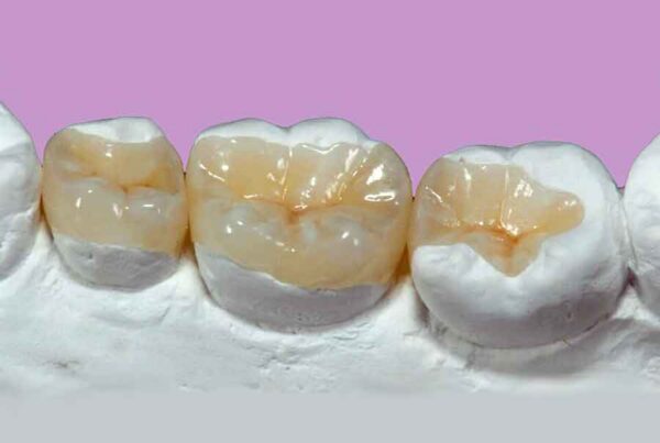 Inlay & Onlay Cost in Richmond, TX | Best Dental