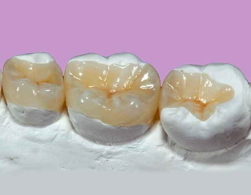 Inlay & Onlay Cost in Richmond, TX | Best Dental