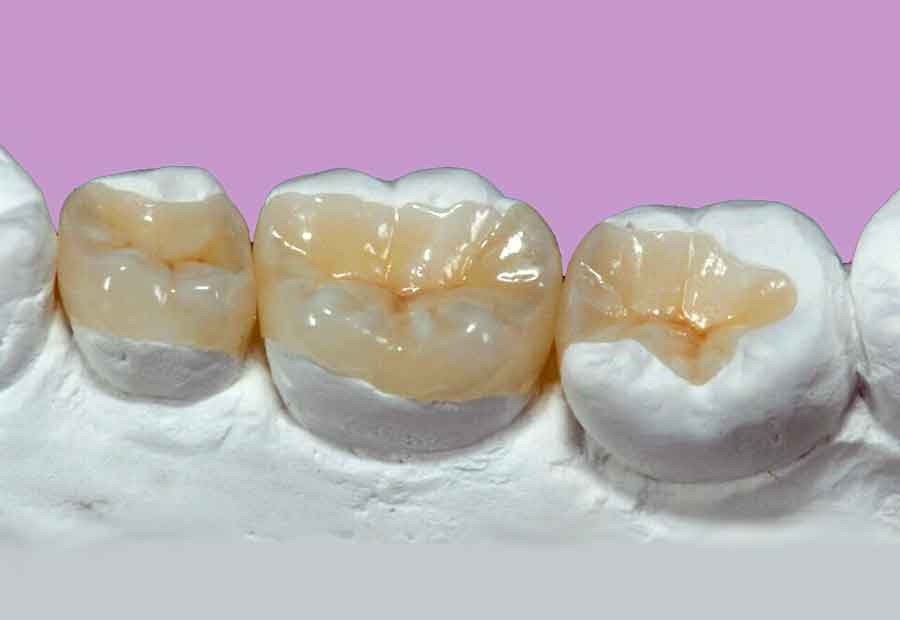 Inlay & Onlay Cost In Richmond, TX