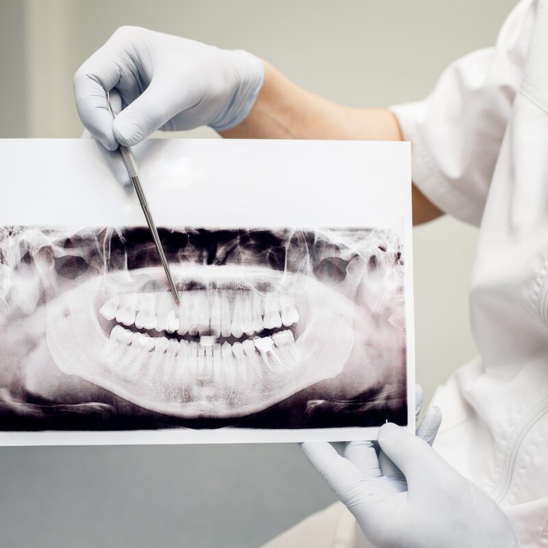 Dental Bridge Cost in Katy, TX — Affordable Options Near You | Best Dental