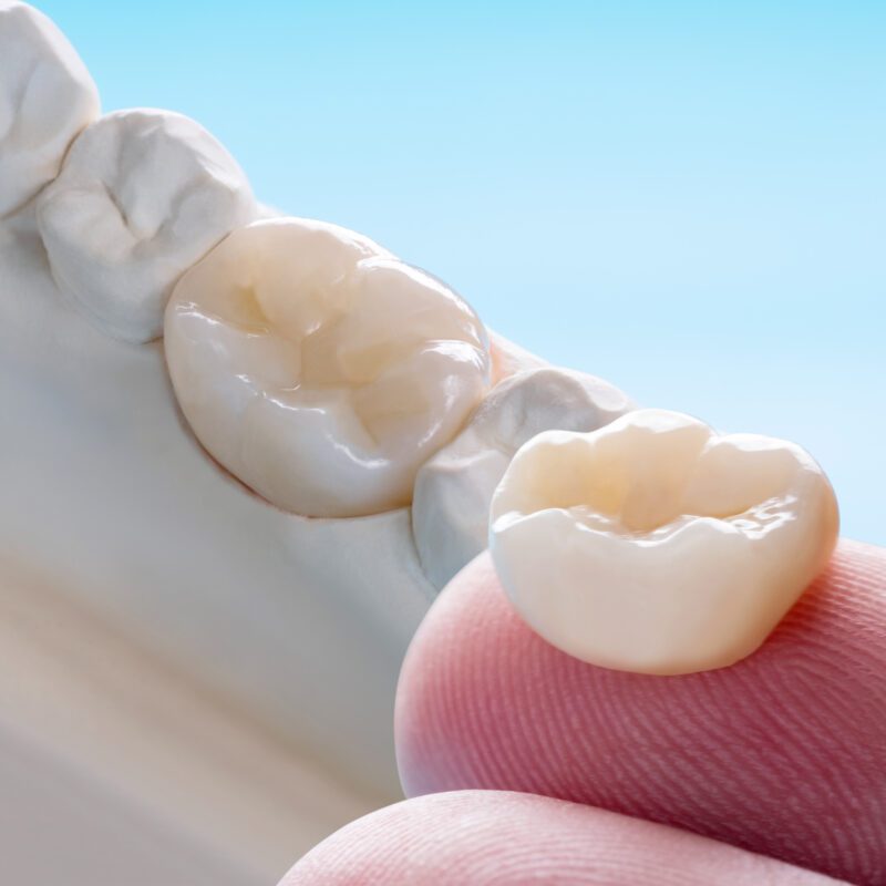 Dental Crown Cost in Rosenberg, TX — Affordable Crowns Near You