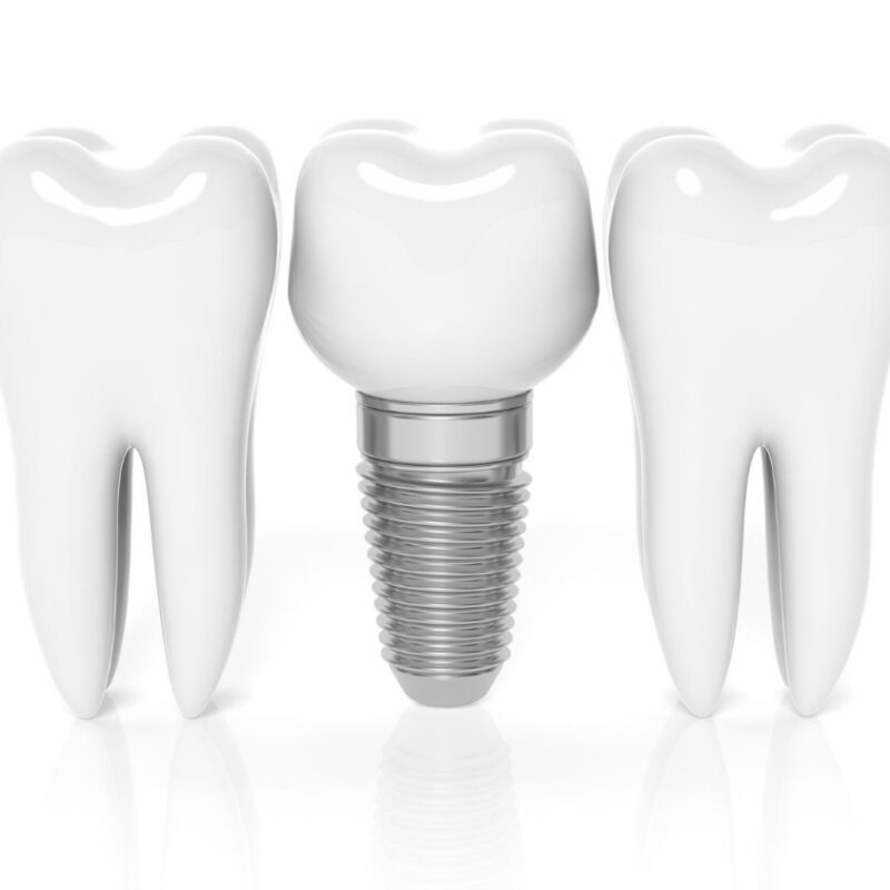 Cheap Dental Implants in Houston, TX | Best Dental